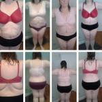 Lipo and tummy tuck before and after photos images after