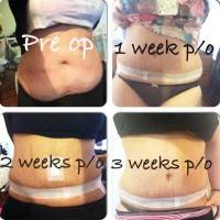 Lipo and tummy tuck before and after photos of patient