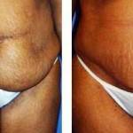 Lipo and tummy tuck before and after photos surgeons
