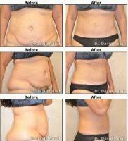 Lipo and tummy tuck operation before and after photos