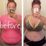 Lipo and tummy tuck procedure before and after photos