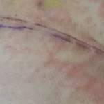 Lipo and tummy tuck scar before and after photos