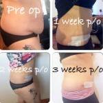 Lipo and tummy tucks before and after photos