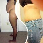 Lipo suction and tummy tuck before and after photos