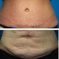 Liposuction abdominoplasty before and after