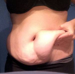Liposuction or abdominoplasty image