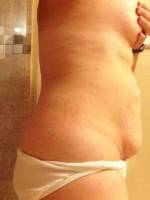 Loose skin on stomach photo