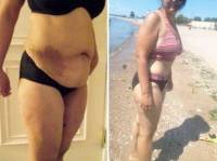 Lose weight before surgery picture before and after