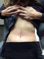 Low tummy tuck scars picture