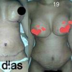 Mini tummy tuck before after gallery