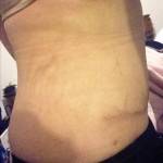 Mini tummy tuck before after images