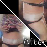 Mini tummy tuck before after operation