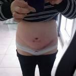 Mini tummy tuck before after scar stips