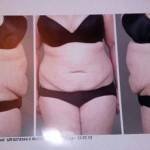 Mini tummy tuck before after surgeon best