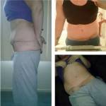 Mini tummy tuck pictures before after