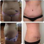 Mini tummy tuck scars before after