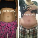 Photo tummy tuck and lipo before and after