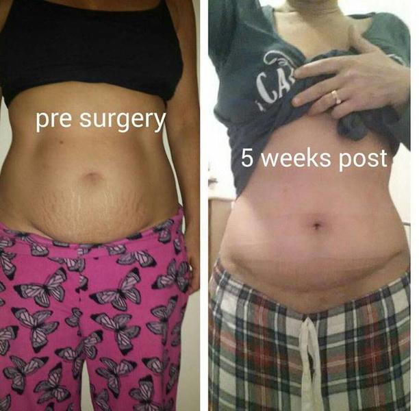 mini tummy tuck before and after pictures
