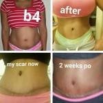 Pictures of tummy tuck and lipo before and after