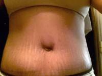 Pictures of tummy tucks after pregnancy images