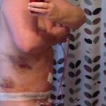 Recovery tummy tuck surgery pictures