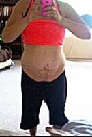 Surgery to remove excess skin on stomach image