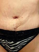 The abdominal plastic surgery