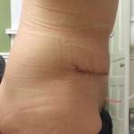 The full tummy tuck pictures