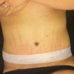 The great tummy tuck results