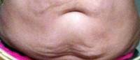 The loose abdominal skin