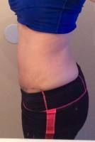 The tummy tuck after surgery photo
