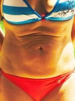 The tummy tuck after weight loss surgery