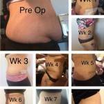 The tummy tuck pictures before and after