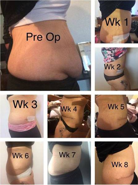The Tummy Tuck Pictures Before And After Tummy Tuck Prices Photos Reviews Info Qanda 