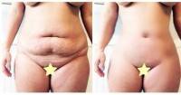The tummy tuck results before and after expectations