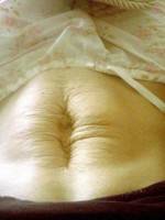 The vertical tummy tuck scar