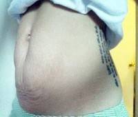 Tightening stomach skin photo