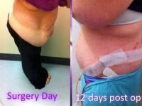 Tummy surgery after pregnancy before and after