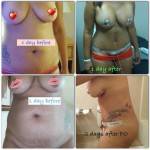 Tummy tuck abdominoplasty before and after pics