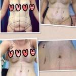 Tummy tuck abdominoplasty pictures before and after