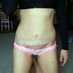 Tummy tuck after dramatic weight loss pictures