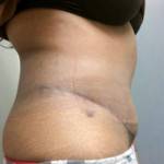 Tummy tuck after weight loss before and after pictures scar