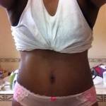 Tummy tuck after weight loss photos