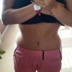 Tummy tuck after weight loss pictures patient