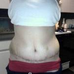 Tummy tuck after weight loss pictures scar