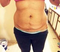 Tummy tuck after weight loss surgery photo