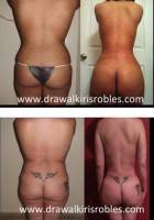 Tummy tuck and buttock lift before and after