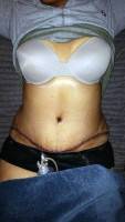 Tummy tuck and flank liposuction after surgery