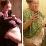 Tummy tuck and lipo before and after massive weight loss