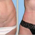 Tummy tuck and lipo before and after of best surgeons